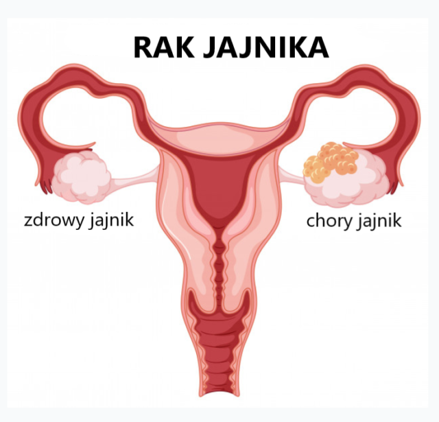 Oznaki I Objawy Raka Jajnika Które Kobiety Często Ignorują F7dobry 3019